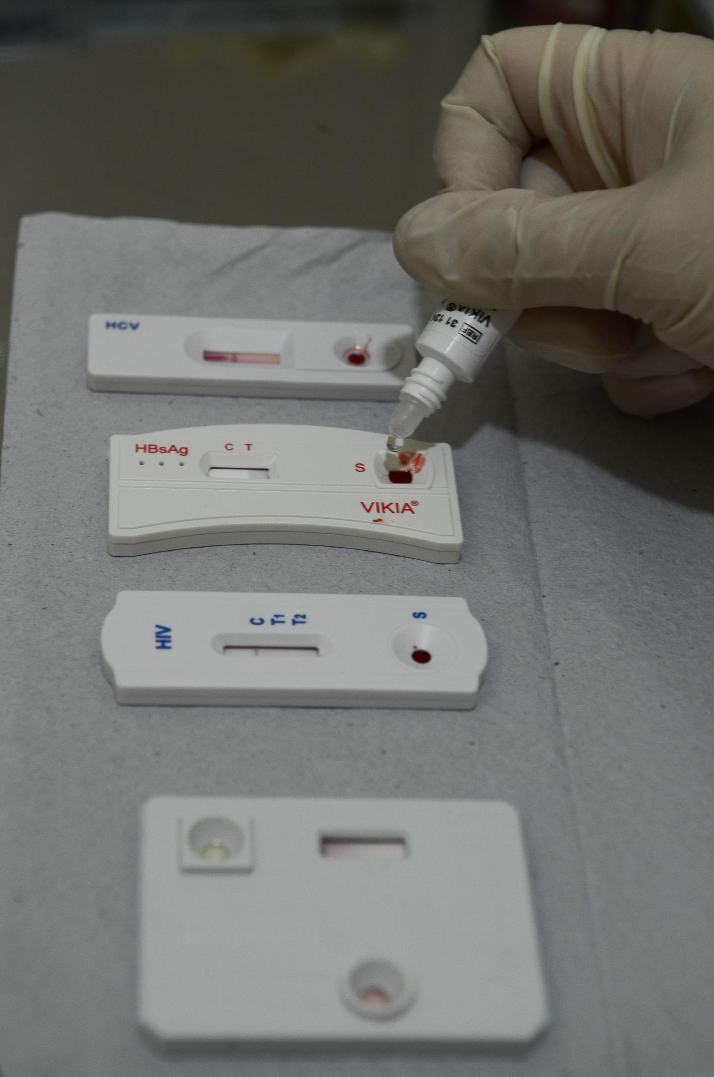 HIV no Amapá: casos sobem 19% em um ano e especialistas destacam prevenção